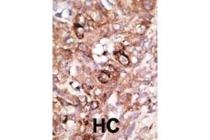 Formalin-fixed and paraffin-embedded human cancer tissue reacted with the primary antibody, which was peroxidase-conjugated to the secondary antibody, followed by AEC staining. (BAD 抗体  (AA 92-127))