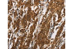 Immunohistochemistry (IHC) image for anti-Cancer/testis Antigen 1A (CTAG1A) (Internal Region) antibody (ABIN7189369)