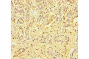 Immunohistochemistry of paraffin-embedded human pancreatic cancer using ABIN7176008 at dilution of 1:100 (ZSCAN29 抗体  (AA 1-300))