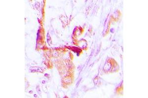 Immunohistochemical analysis of EEF2 staining in human lung cancer formalin fixed paraffin embedded tissue section. (EEF2 抗体  (N-Term))