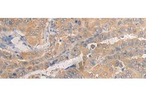 Immunohistochemistry of paraffin-embedded Human thyroid cancer tissue using AGAP3 Polyclonal Antibody at dilution of 1:25(x200) (AGAP3 抗体)