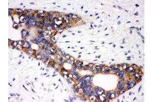 Anti- AGTR1 Picoband antibody, IHC(P) IHC(P): Human Mammary Cancer Tissue (Angiotensin II Type-1 Receptor 抗体  (N-Term))