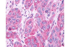 Anti-GPR61 antibody IHC of human Skin, Melanoma. (GPR61 抗体  (N-Term))