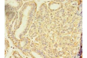 Immunohistochemistry of paraffin-embedded human breast cancer using ABIN7166213 at dilution of 1:100 (SEC31A 抗体  (AA 335-503))