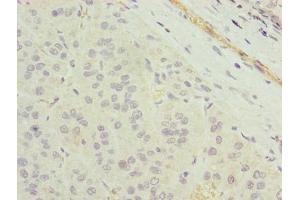 Immunohistochemistry of paraffin-embedded human liver cancer using ABIN7173103 at dilution of 1:100 (TMEM177 抗体  (AA 219-311))