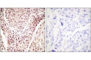 Immunohistochemistry analysis of paraffin-embedded human breast carcinoma, using Chk2 (Phospho-Thr387) Antibody. (CHEK2 抗体  (pThr387))