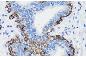 Immunohistochemistry of paraffin-embedded Human breast cancer using FLNA Polyclonal Antibody at dilution of 1:100 (40x lens).