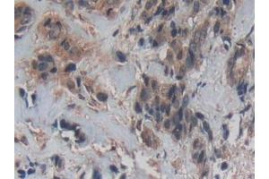 Detection of Cys-C in Human Breast cancer Tissue using Polyclonal Antibody to Cystatin C (Cys-C) (Cystathionine-gamma-Synthase Precursor (CYS) (AA 27-146) 抗体)