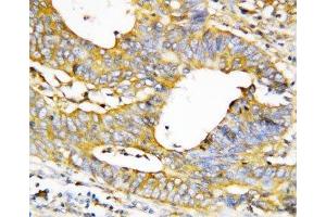 IHC-P testing of human breast cancer tissue (Caspase 1 抗体  (Large Subunit, N-Term))