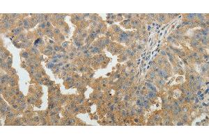 Immunohistochemistry of paraffin-embedded Human ovarian cancer tissue using SYT6 Polyclonal Antibody at dilution 1:40 (SYT6 抗体)