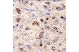 Formalin-fixed and paraffin-embedded human hepatocarcinoma tissue reacted with ZBTB7B antibody (Center), which was peroxidase-conjugated to the secondary antibody, followed by DAB staining. (ZBTB7B 抗体  (Middle Region))