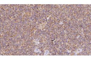 ABIN6273196 at 1/100 staining Human lymph cancer tissue by IHC-P. (ASRGL1 抗体  (Internal Region))