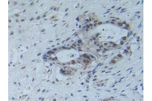 Detection of Raftlin in Human Pancreas Cancer Tissue using Polyclonal Antibody to Raft Linking Protein (Raftlin) (RFTN1 抗体  (AA 288-520))