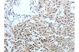 The image on the left is immunohistochemistry of paraffin-embedded Human lung cancer tissue using ABIN7128892(CEACAM1 Antibody) at dilution 1/25, on the right is treated with fusion protein. (CEACAM1 抗体)