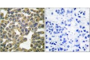 Immunohistochemistry (IHC) image for anti-Matrix Metallopeptidase 13 (Collagenase 3) (MMP13) (AA 10-59) antibody (ABIN2889227) (MMP13 抗体  (AA 10-59))