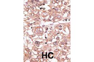 Formalin-fixed and paraffin-embedded human hepatocellular carcinoma tissue reacted with TLR7 polyclonal antibody  , which was peroxidase-conjugated to the secondary antibody, followed by AEC staining. (TLR7 抗体  (N-Term))