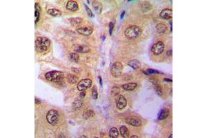 Immunohistochemical analysis of SIAH2 staining in human breast cancer formalin fixed paraffin embedded tissue section. (SIAH2 抗体  (C-Term))