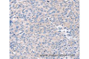 Immunohistochemistry of Human prostate cancer using ROR1 Polyclonal Antibody at dilution of 1:35 (ROR1 抗体)