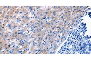 Immunohistochemistry of paraffin-embedded Human liver cancer tissue using LAMA3 Polyclonal Antibody at dilution 1:30 (LAMA3 抗体)