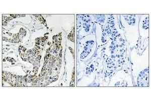 Immunohistochemical analysis of paraffin-embedded human breast carcinoma tissue using BLK (Phospho-Tyr501) antibody (left)or the same antibody preincubated with blocking peptide (right). (BLK 抗体  (pTyr501))