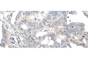 Immunohistochemistry of paraffin-embedded Human liver cancer tissue using NOG Polyclonal Antibody at dilution of 1:50(x200) (NOG 抗体)