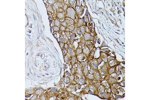 Immunohistochemistry of paraffin-embedded human breast cancer using β-Catenin antibody (ABIN7266137) at dilution of 1:100 (40x lens). (CTNNB1 抗体)