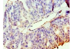 Immunohistochemistry of paraffin-embedded human endometrial cancer using ABIN7169127 at dilution of 1:100 (PAK2 抗体  (AA 1-212))