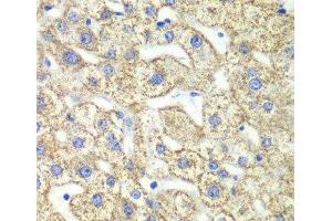 Immunohistochemistry of paraffin-embedded Human liver damage using GLUD2 Polyclonal Antibody at dilution of 1:100 (40x lens).