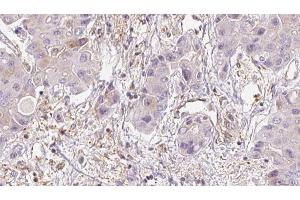 ABIN6273950 at 1/100 staining Human liver cancer tissue by IHC-P. (MRGPRD 抗体  (C-Term))