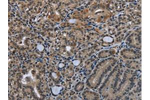 The image on the left is immunohistochemistry of paraffin-embedded Human thyroid cancer tissue using ABIN7129587(GDF3 Antibody) at dilution 1/25, on the right is treated with fusion protein. (GDF3 抗体)