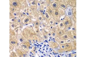 Immunohistochemistry of paraffin-embedded Human liver damage using CARD11 Polyclonal Antibody at dilution of 1:100 (40x lens). (CARD11 抗体)