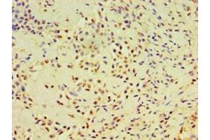 Immunohistochemistry of paraffin-embedded human breast cancer using ABIN7164384 at dilution of 1:100 (DHX58 抗体  (AA 389-678))