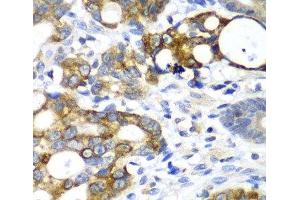 Immunohistochemistry of paraffin-embedded Human gastric cancer using AMY2A Polyclonal Antibody at dilution of 1:100 (40x lens). (AMY2A 抗体)