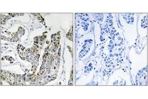 Immunohistochemistry analysis of paraffin-embedded human breast carcinoma, using BLK (Phospho-Tyr501) Antibody. (BLK 抗体  (pTyr501))