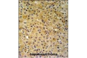 NDUFA10 Antibody (Center) (ABIN653725 and ABIN2843032) IHC analysis in formalin fixed and paraffin embedded hepatocarcinoma followed by peroxidase conjugation of the secondary antibody and DAB staining. (NDUFA10 抗体  (AA 252-281))