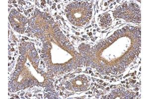 IHC-P Image Immunohistochemical analysis of paraffin-embedded human colon carcinoma, using SERCA3, antibody at 1:500 dilution. (ATP2A3 抗体  (N-Term))