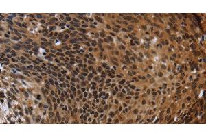 Immunohistochemistry of paraffin-embedded Human cervical cancer using FHL3 Polyclonal Antibody at dilution of 1:40 (FHL3 抗体)