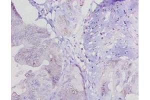 Immunohistochemistry of paraffin-embedded human colon cancer using ABIN7158833 at dilution of 1:20 (LOXL1 抗体  (AA 106-574))