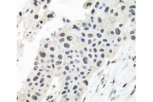 Immunohistochemistry of paraffin-embedded Human lung cancer using CDCA8 Polyclonal Antibody at dilution of 1:100 (40x lens). (CDCA8 抗体)