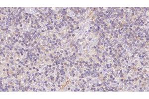 ABIN6273117 at 1/100 staining Human lymph cancer tissue by IHC-P. (FECH 抗体  (C-Term))