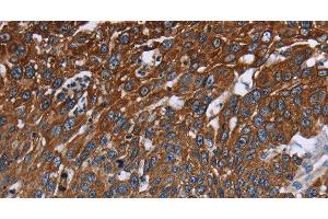 Immunohistochemistry of paraffin-embedded Human lung cancer tissue using FCGR3A Polyclonal Antibody at dilution 1:40 (FCGR3A 抗体)