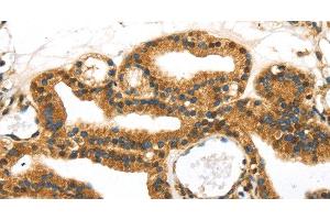 Immunohistochemistry of paraffin-embedded Human thyroid cancer tissue using SERPINB8 Polyclonal Antibody at dilution 1:40 (SERPINB8 抗体)