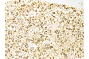 Immunohistochemistry of paraffin-embedded human kidney cancer using PLCB1 antibody.