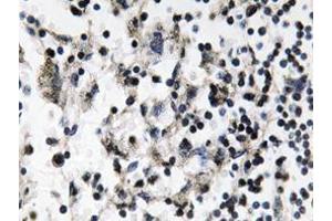 Immunohistochemistry analyzes of Catenin-β antibody in paraffin-embedded human breast carcinoma tissue. (CDC37 抗体)
