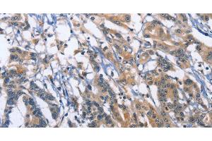 Immunohistochemistry of paraffin-embedded Human colon cancer using SYT17 Polyclonal Antibody at dilution of 1:60 (SYT17 抗体)