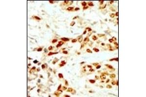 Formalin-fixed and paraffin-embedded human cancer tissue reacted with the primary antibody, which was peroxidase-conjugated to the secondary antibody, followed by DAB staining. (DAPK2 抗体  (N-Term))