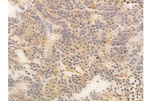 ABIN6266068 and ABIN6266678 at 1/100 staining human pituitary adenoma by IHC-P.