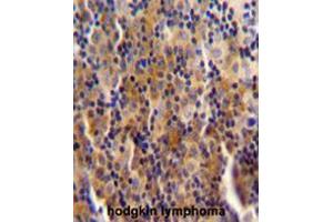 SYNE3 antibody (C-term) immunohistochemistry analysis in formalin fixed and paraffin embedded human hodgkin lymphoma followed by peroxidase conjugation of the secondary antibody and DAB staining. (Nesprin3 抗体  (C-Term))