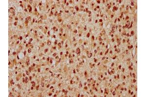 IHC image of ABIN7175822 diluted at 1:300 and staining in paraffin-embedded human glioma performed on a Leica BondTM system. (WAPAL 抗体  (AA 1037-1190))