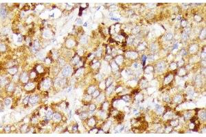 Immunohistochemistry of paraffin-embedded Human liver cancer using GALC Polyclonal Antibody at dilution of 1:100 (40x lens). (GALC 抗体)
